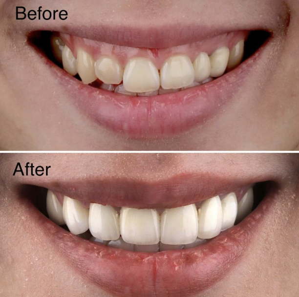 Veneer Komposit