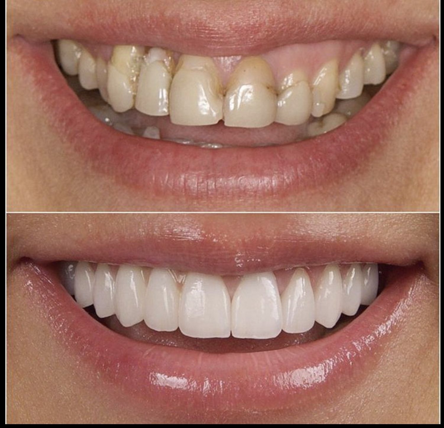 Teeth Whitening